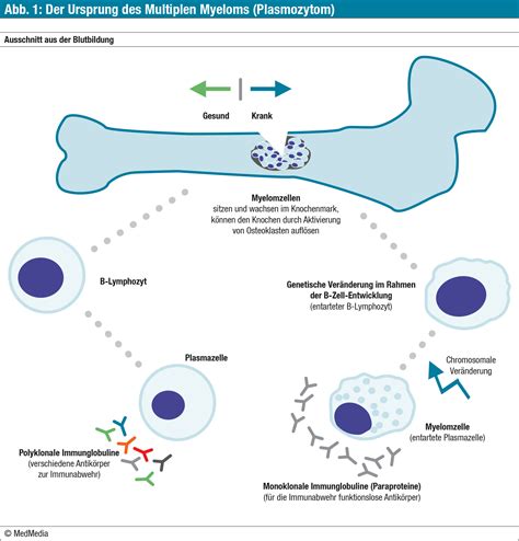 crap mm|Multiples Myelom — Onkopedia.